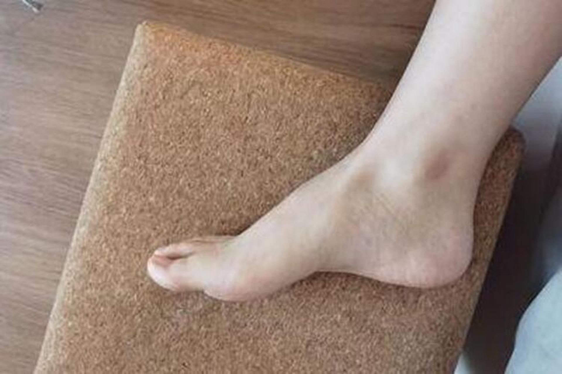 90症状 高脚背脚型足弓较高,前足可呈马蹄状,负重点分布在第一和第