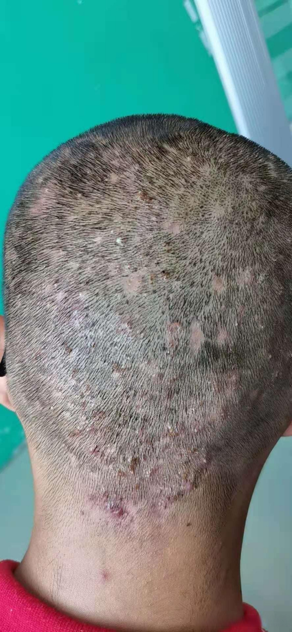 毛囊炎真的很讨厌,但如果你不注意生活习惯,吃再多药也没用!