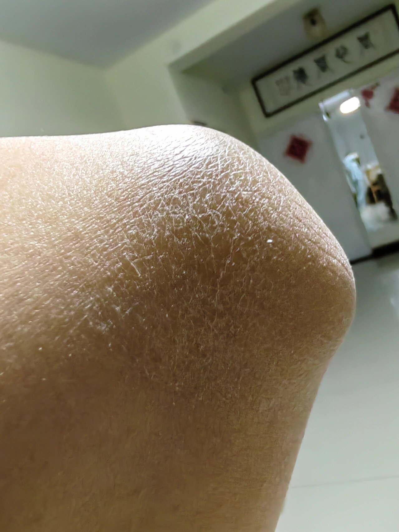 胳膊肘皮肤干皮