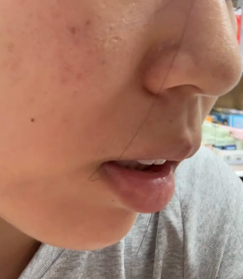 牙齿往前凸是可以矫正的,具体方法要根据病因来选择