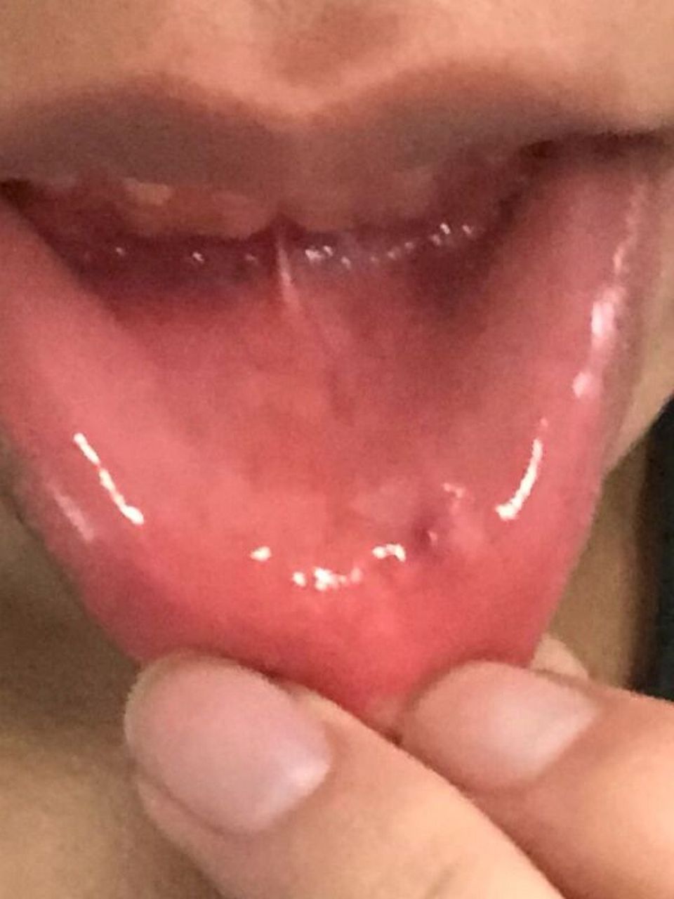 嘴唇上长了个小红点(照片在图二) 今天刚长,像口腔溃疡一样肿了,一点