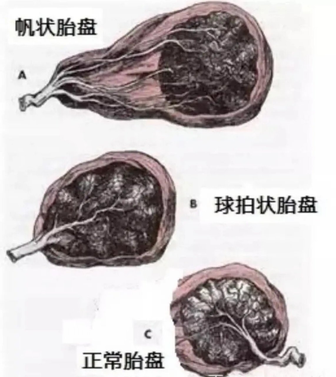 孕晚期了,球拍状胎盘翻盘6015 在24周做胎儿生长测量的时候 医生