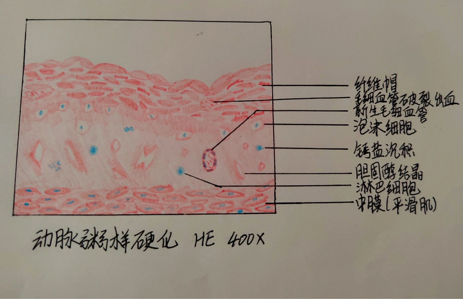 动脉粥样硬化红蓝铅笔图片