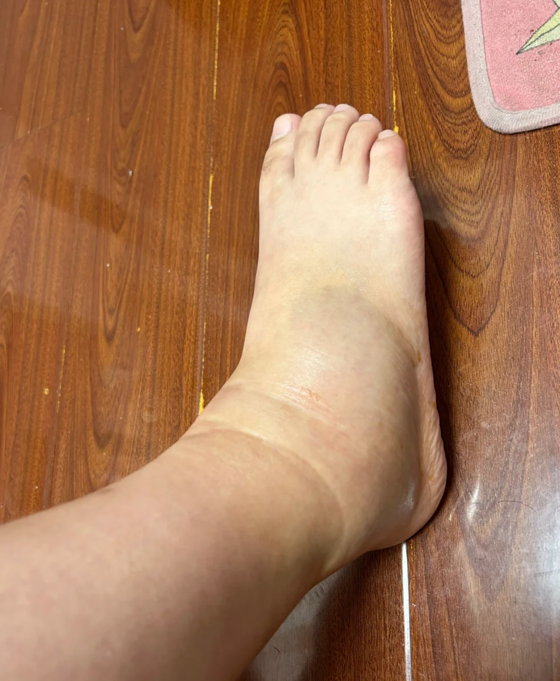 崴脚骨折能不能不打石膏就愈合,这要看骨折的严重程度