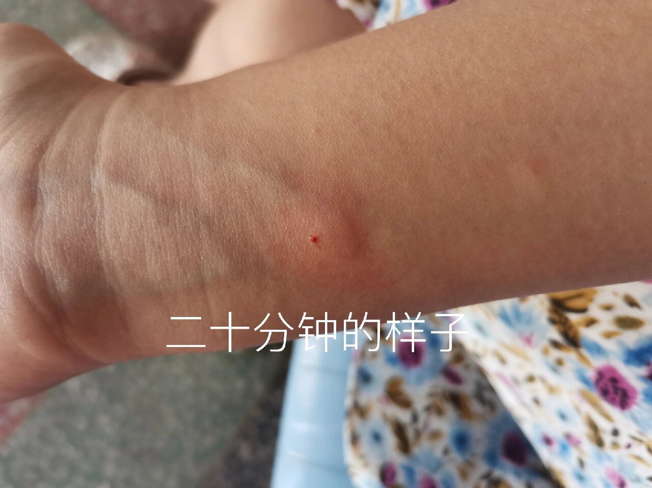 破伤风皮试怎么看是否过敏?