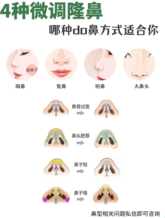 简单地说,鼻骨内推就是对鼻部进行截骨,将截断的鼻骨向内侧挤压,向内