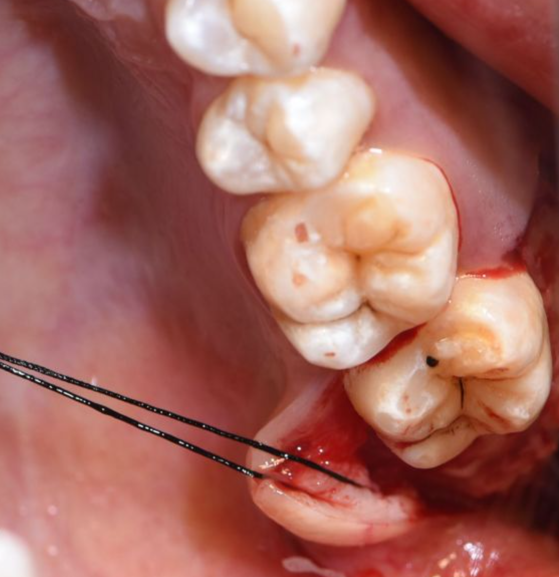 智齿长在牙龈外侧靠近脸颊的位置,这种情况叫阻生智齿