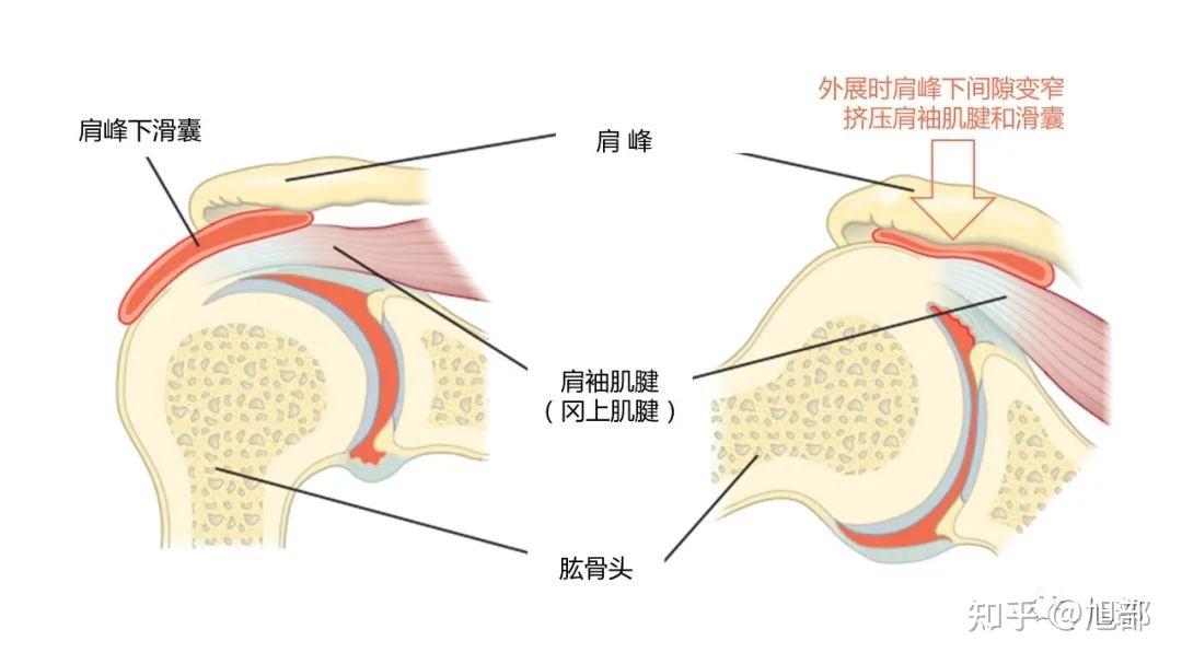 肩峰下撞击综合征肩峰下滑囊炎肩痛的第一罪魁祸首附保守康复锻炼方法