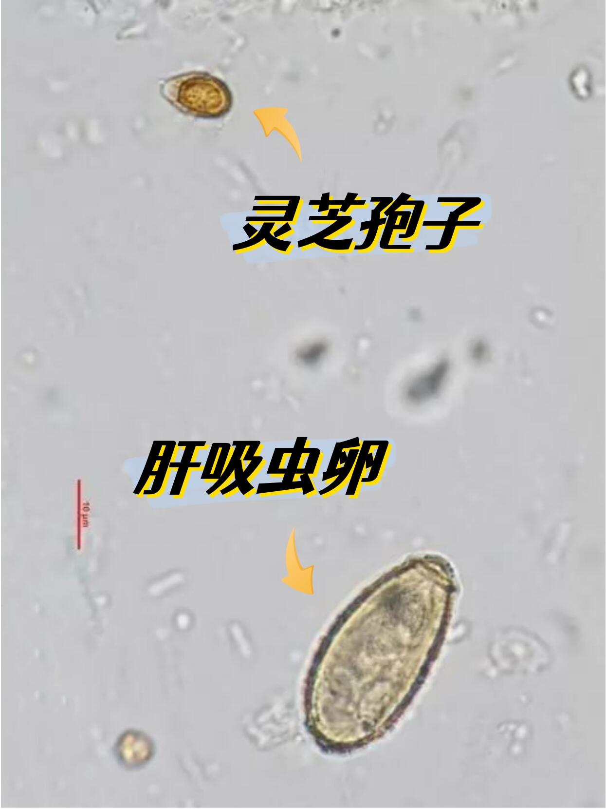 肝吸虫卵vs灵芝孢子 | 大便常规 | 镜下形态 9702	 92 	 肝吸虫