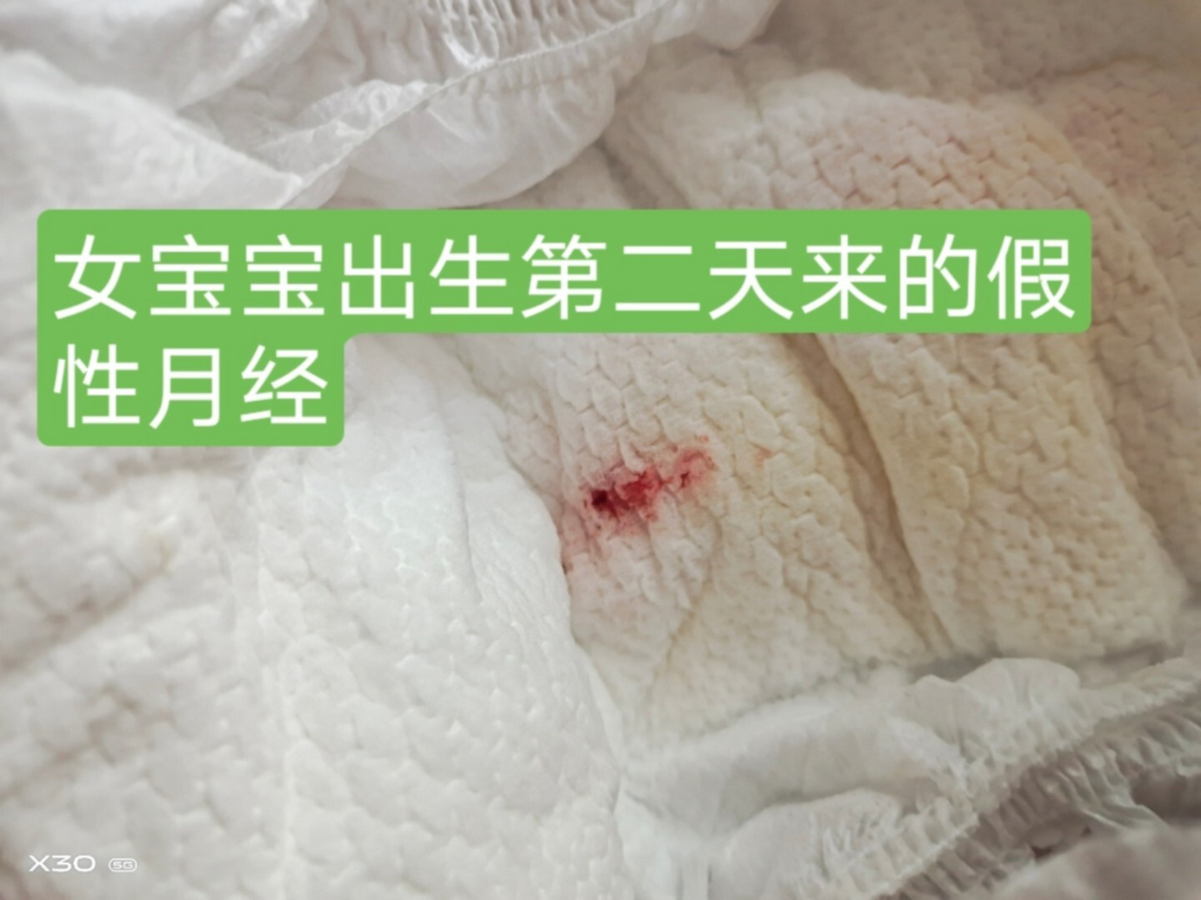 宝宝假性月经,不必担心犹豫一般3天结束