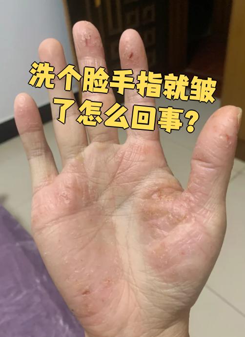 我的手指为什么有那么多皱纹为什么在线 我的手指为什么有那么多皱纹为什么在线