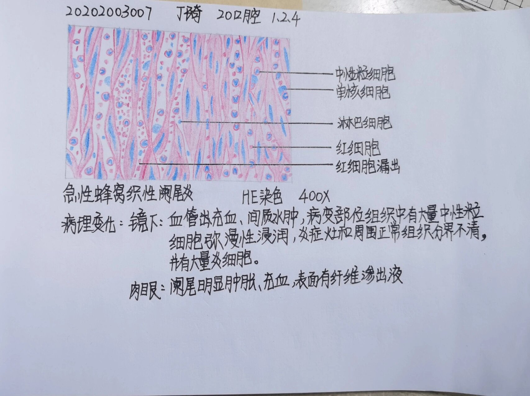 病理红蓝铅笔实验画图 急性蜂窝织性阑尾炎 皮肤癌状细胞癌 肉芽组织