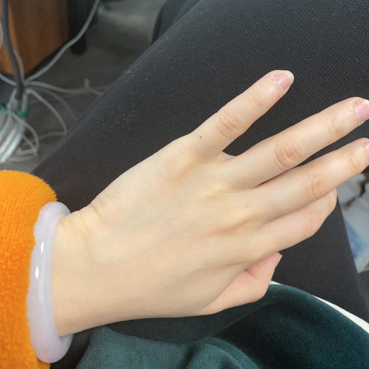 小拇指突然长出来的痣 有什么说法吗?