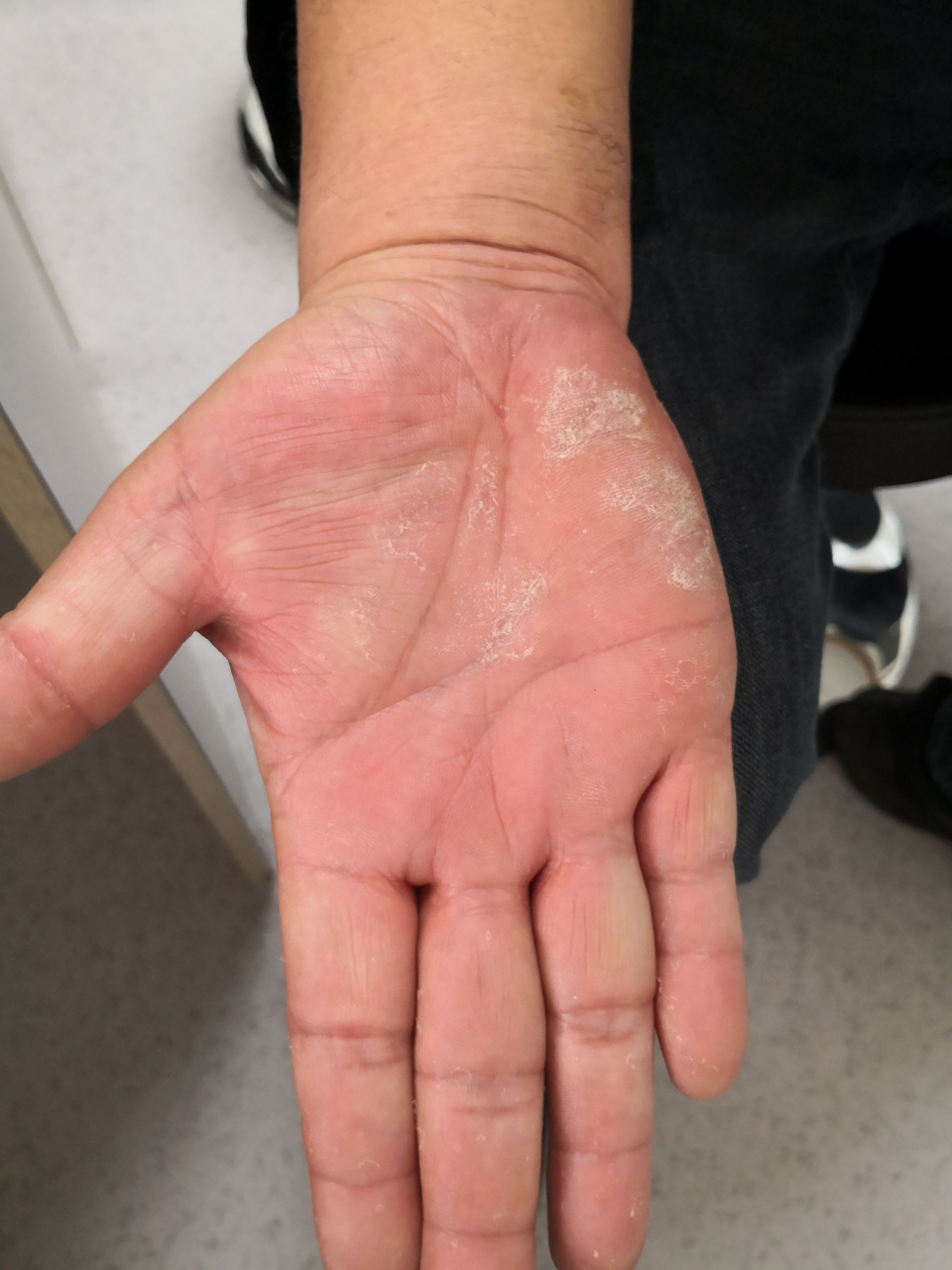 手掌真菌感染症状图片图片