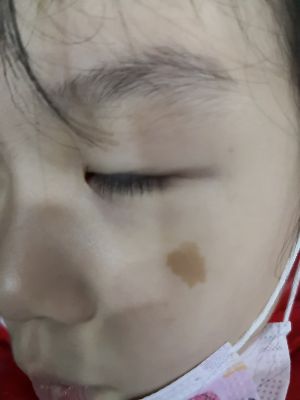 面部咖啡斑症状.可以手术切除治疗.美容效果不错的#美容##皮肤外科