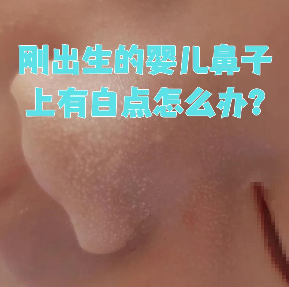 刚出生的婴儿鼻子上有白点怎么办?