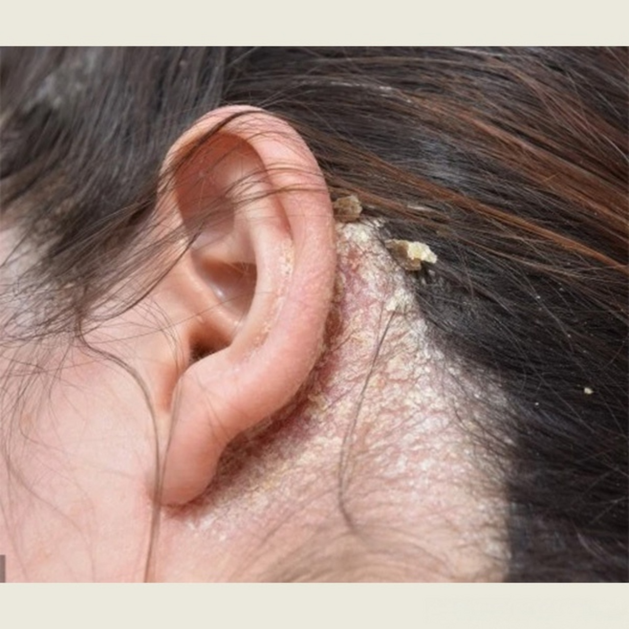 头皮长毛囊炎用什么洗发水? 用了黛熙梦洗发水后,头皮屑完全消失了.