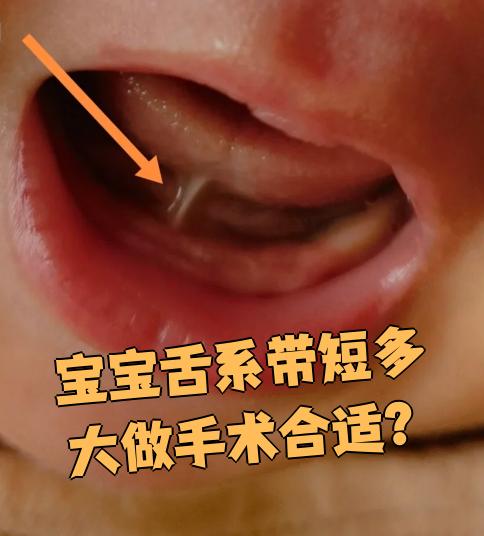 宝宝舌系带短的手术时间建议在两岁左右比较合适