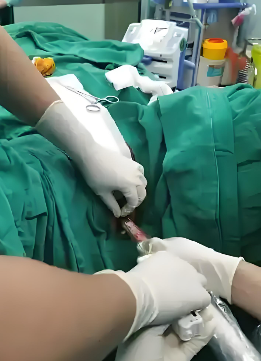 如果是单纯性尿道口狭窄,做尿道外口切除术或尿道