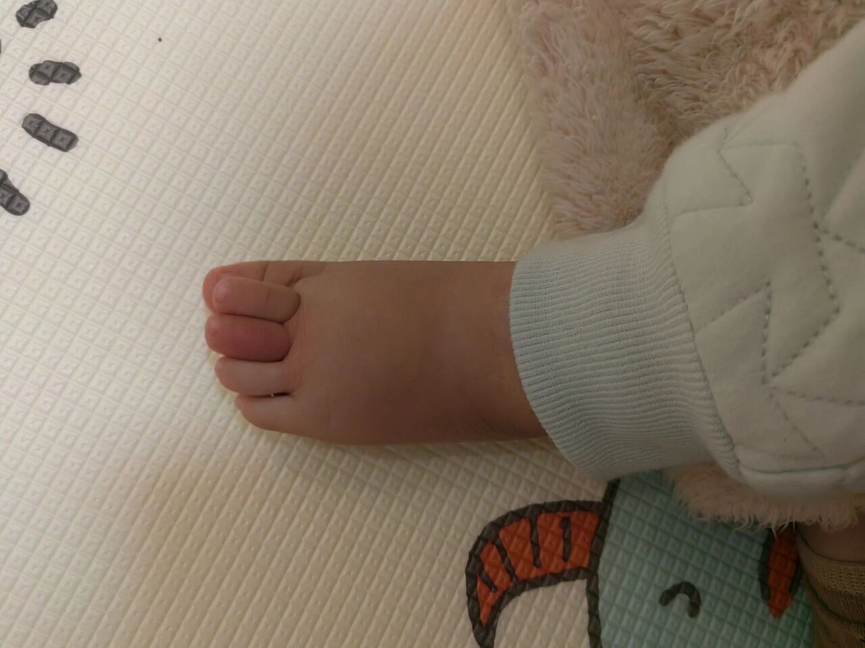 7月  宝宝脚趾头睡一觉起来红肿了,有没有一样的啊?