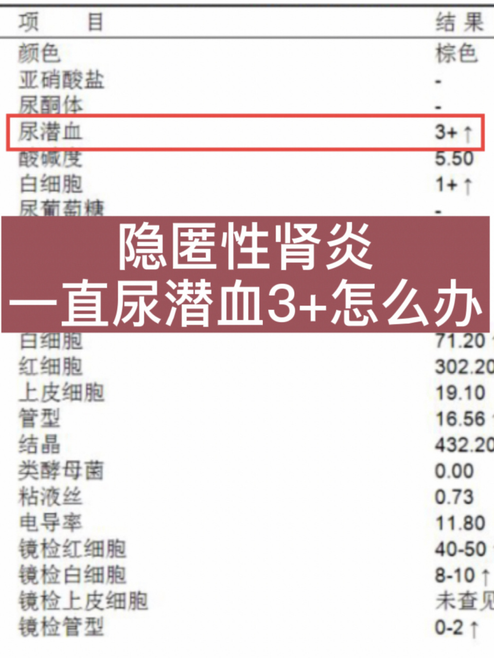 尿潜血三个加号应做以下处理: 1,看尿红细胞个数和形态; 2,进一步