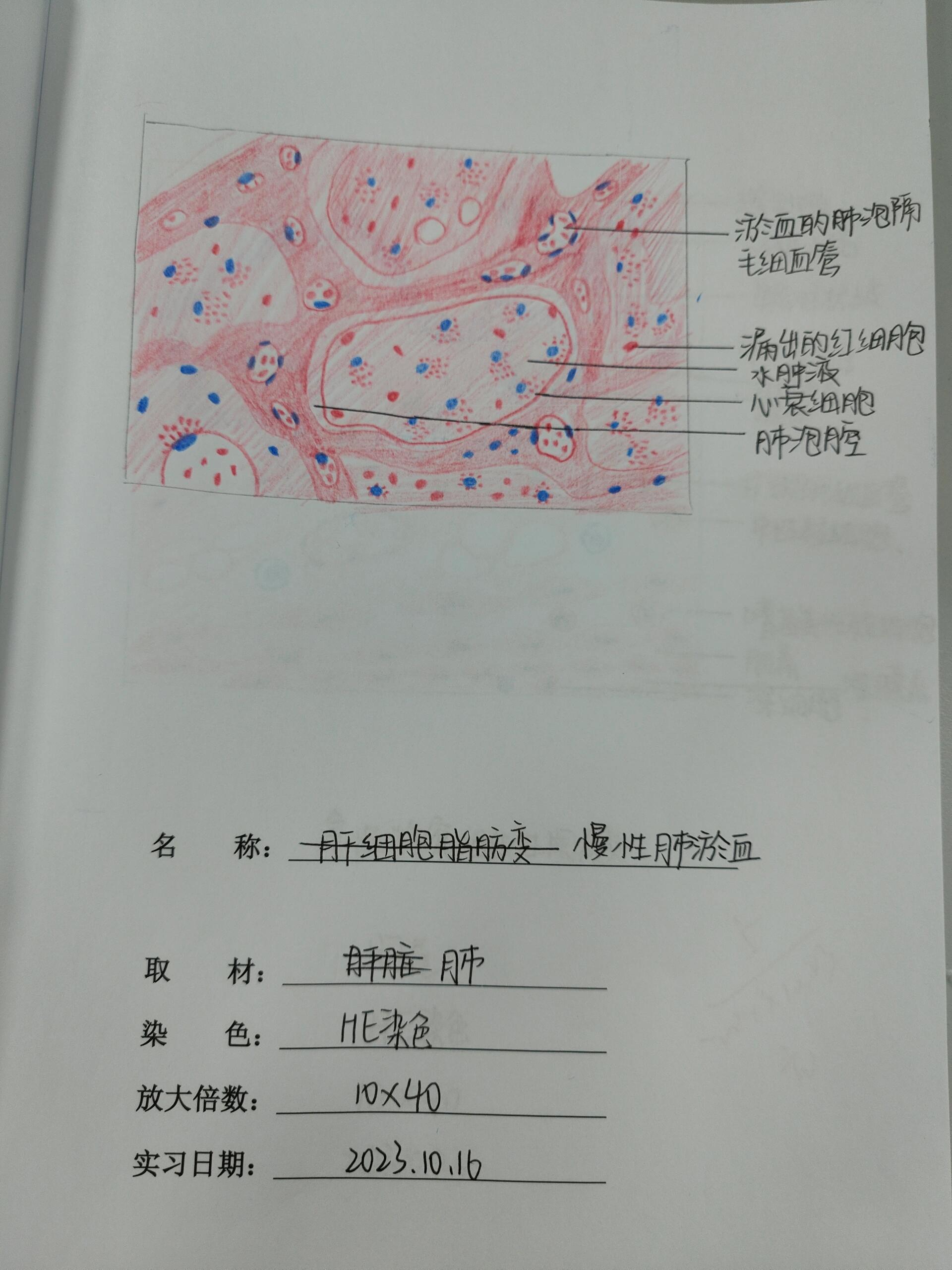 病理学慢性肺淤血红蓝铅笔手绘图