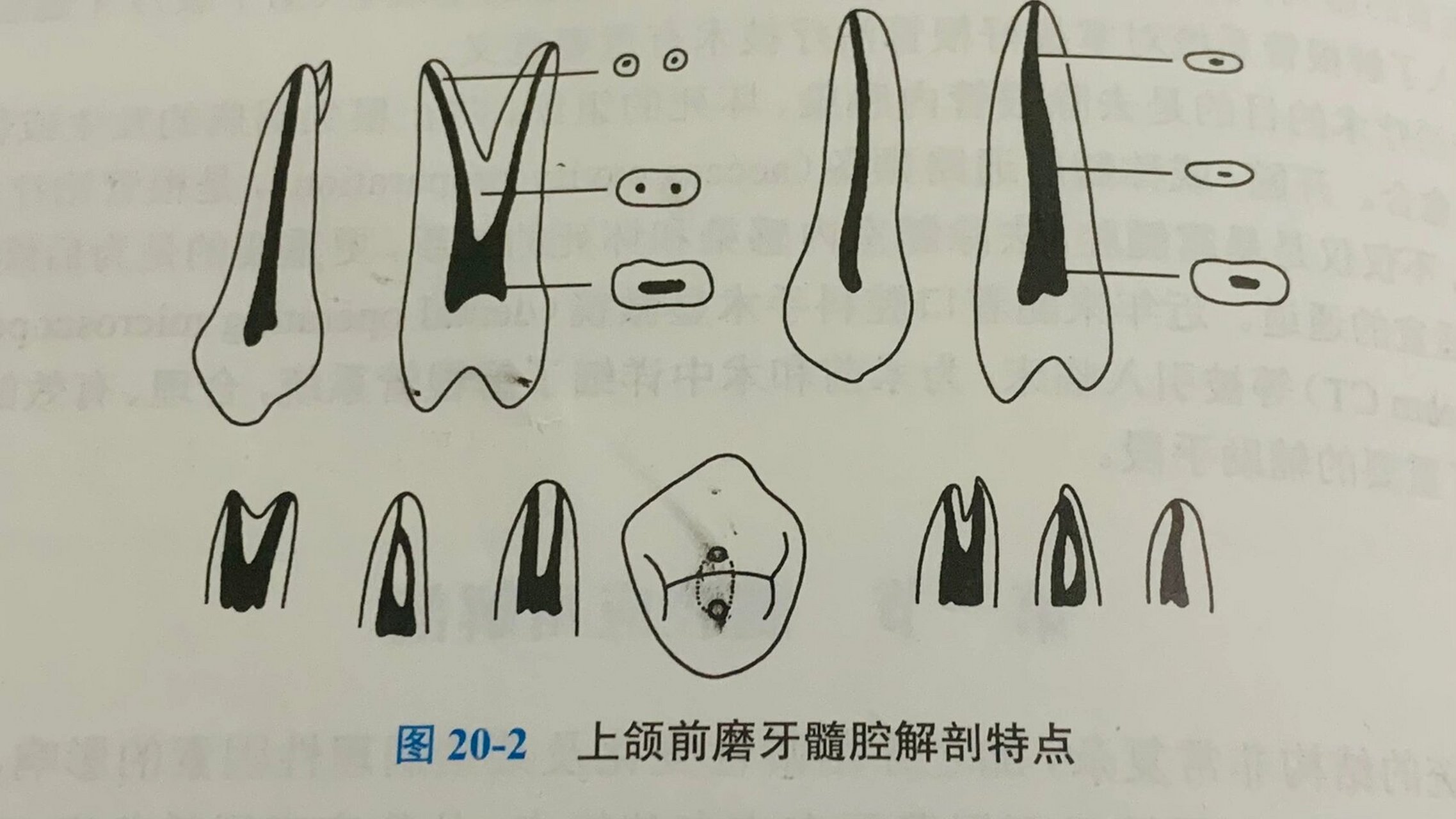 下颌中切牙髓腔形态图片