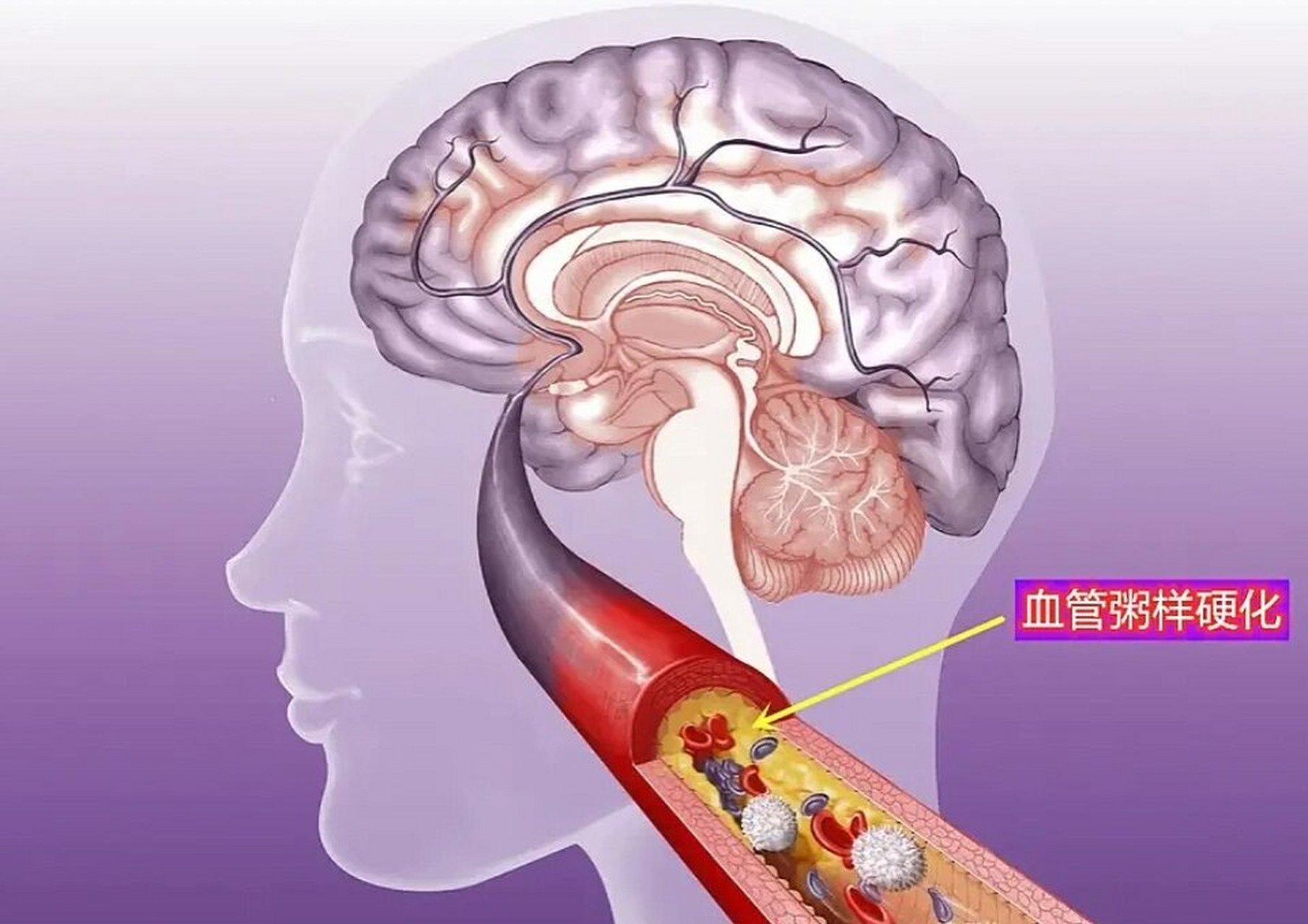 大脑血管堵塞的前兆是什么?