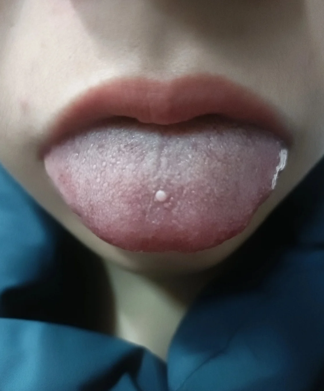舌头上出现白色凸起颗粒,常见原因有以下几种: