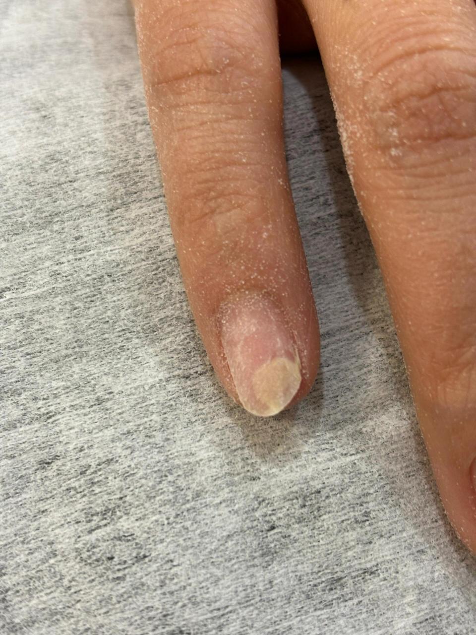 指甲空了,与肉分离,不疼,能做吗?