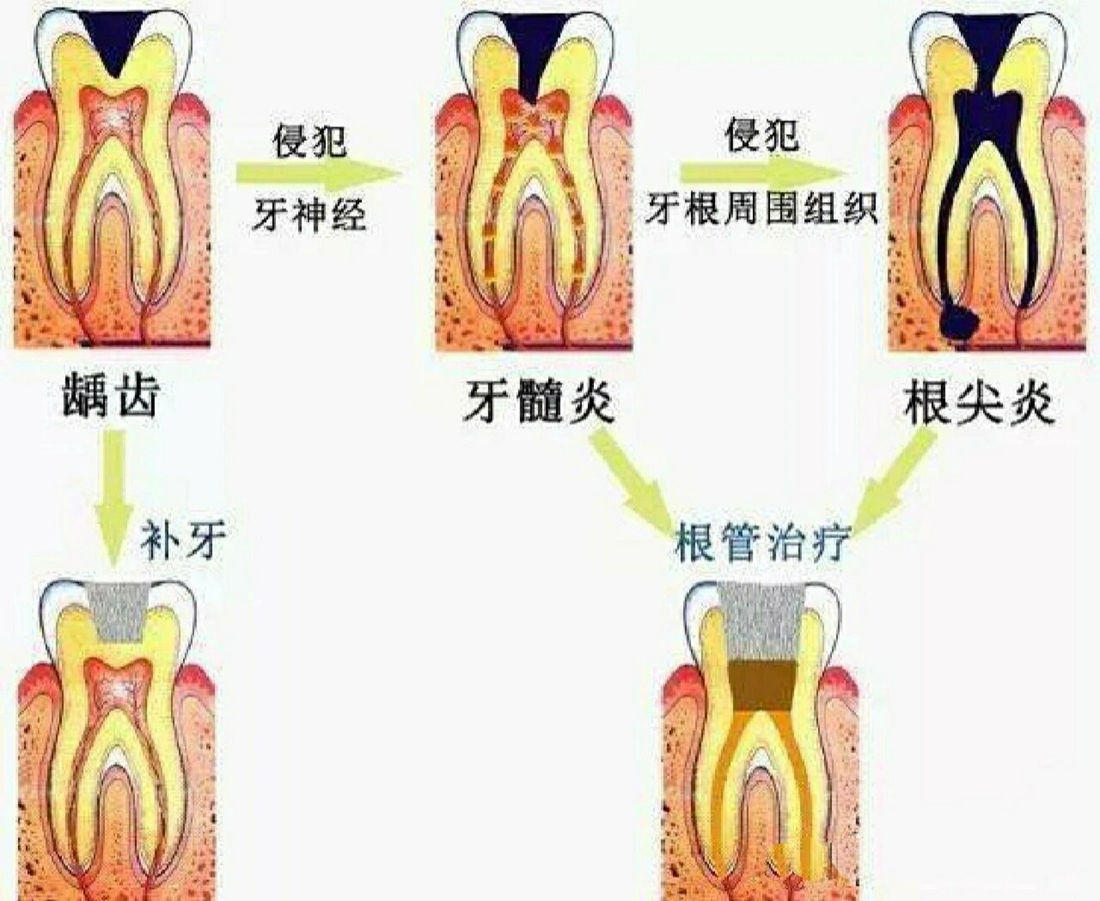 儿童牙根炎症状图片图片