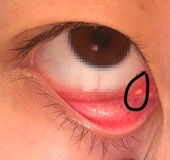 霰粒肿是因为睑板腺腺体分泌出口堵住了,分泌物排不出去,慢慢堆积