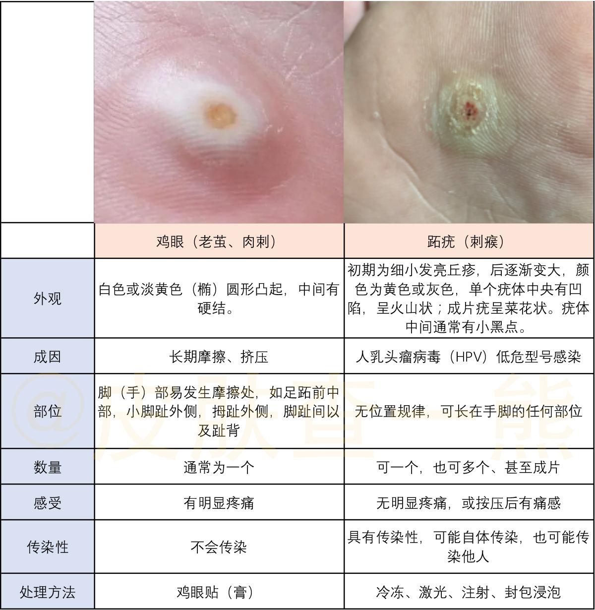 怎么辨别鸡眼和跖疣呀