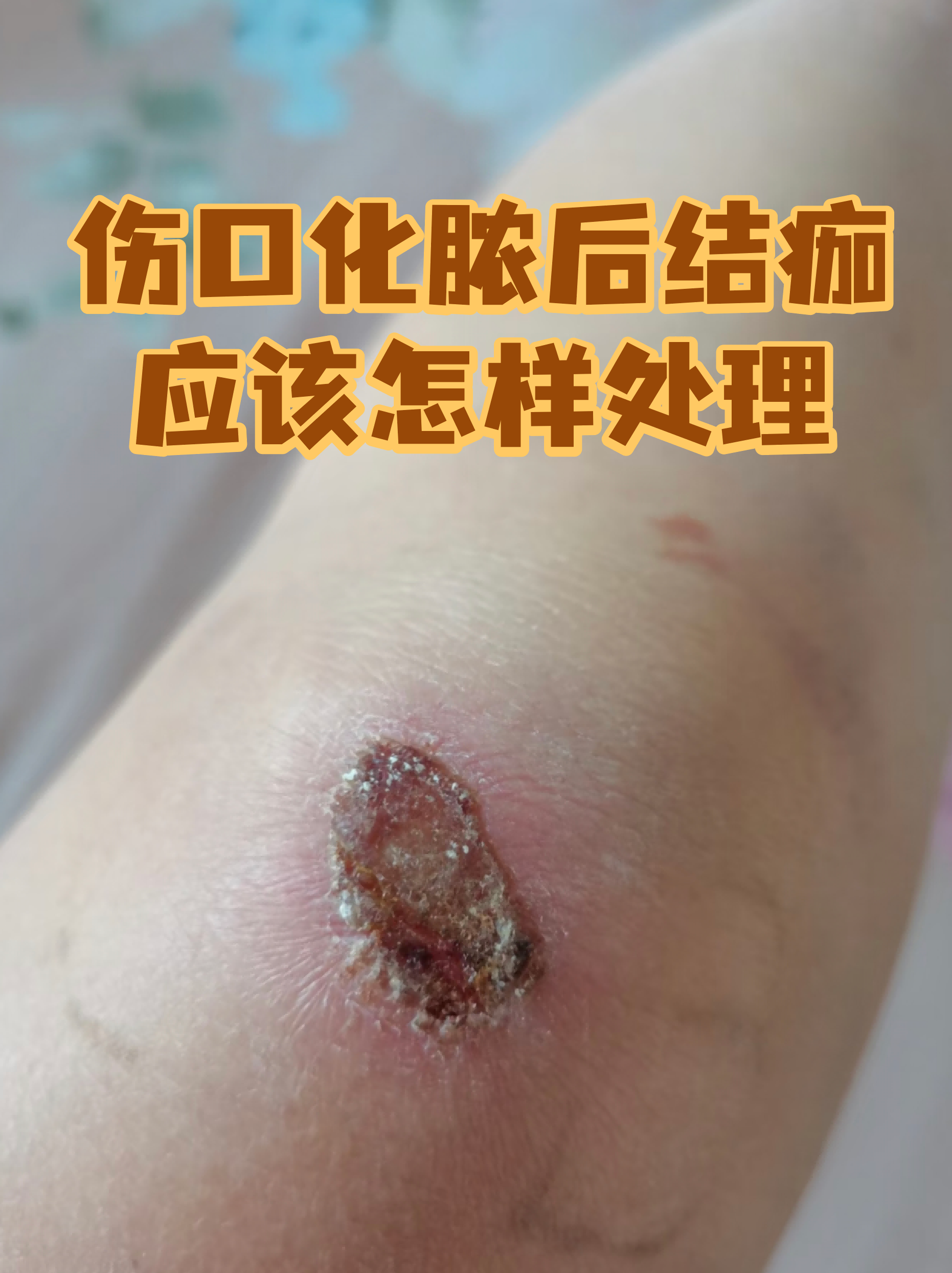 北京大学第六医院全程代诊含挂号术后伤口观察提醒，减少感染风险的简单介绍