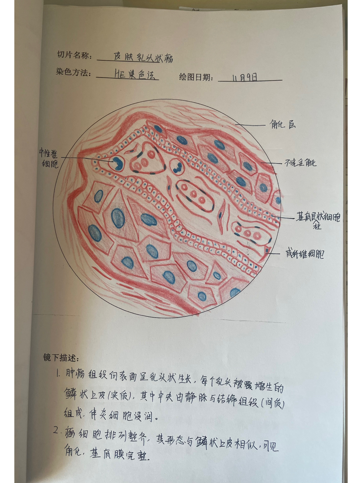 肠腺癌 红蓝铅笔图片