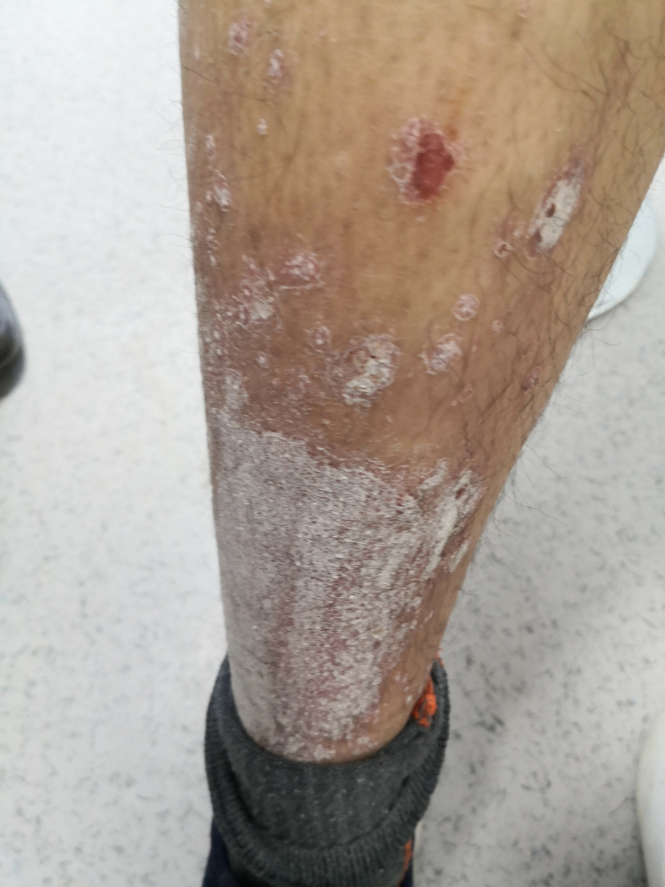 银屑病患者的双小腿伸侧症状.