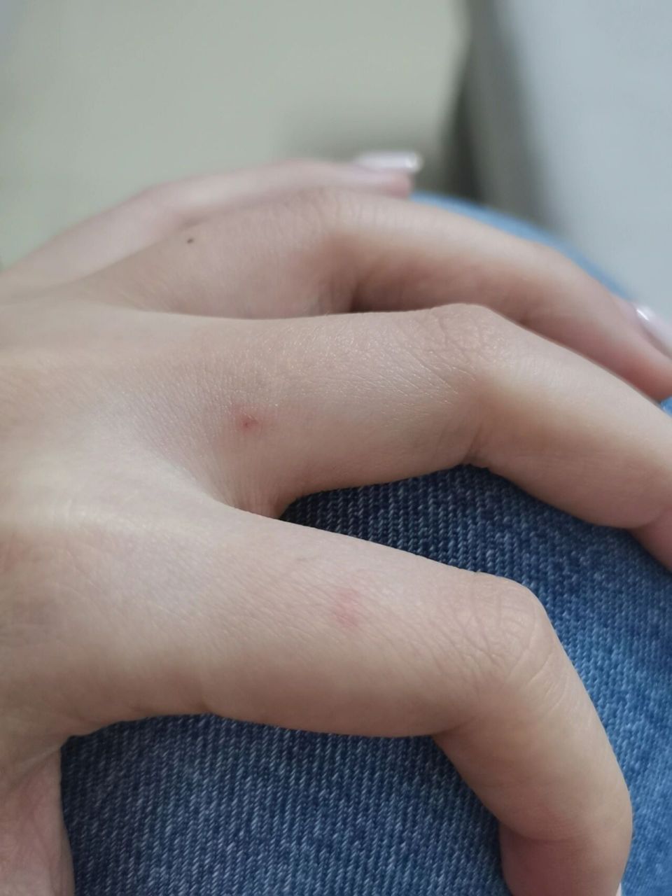 被猫咬了 没有出血但是破皮红了,咬了之后没有消毒也没有冲水 要打针