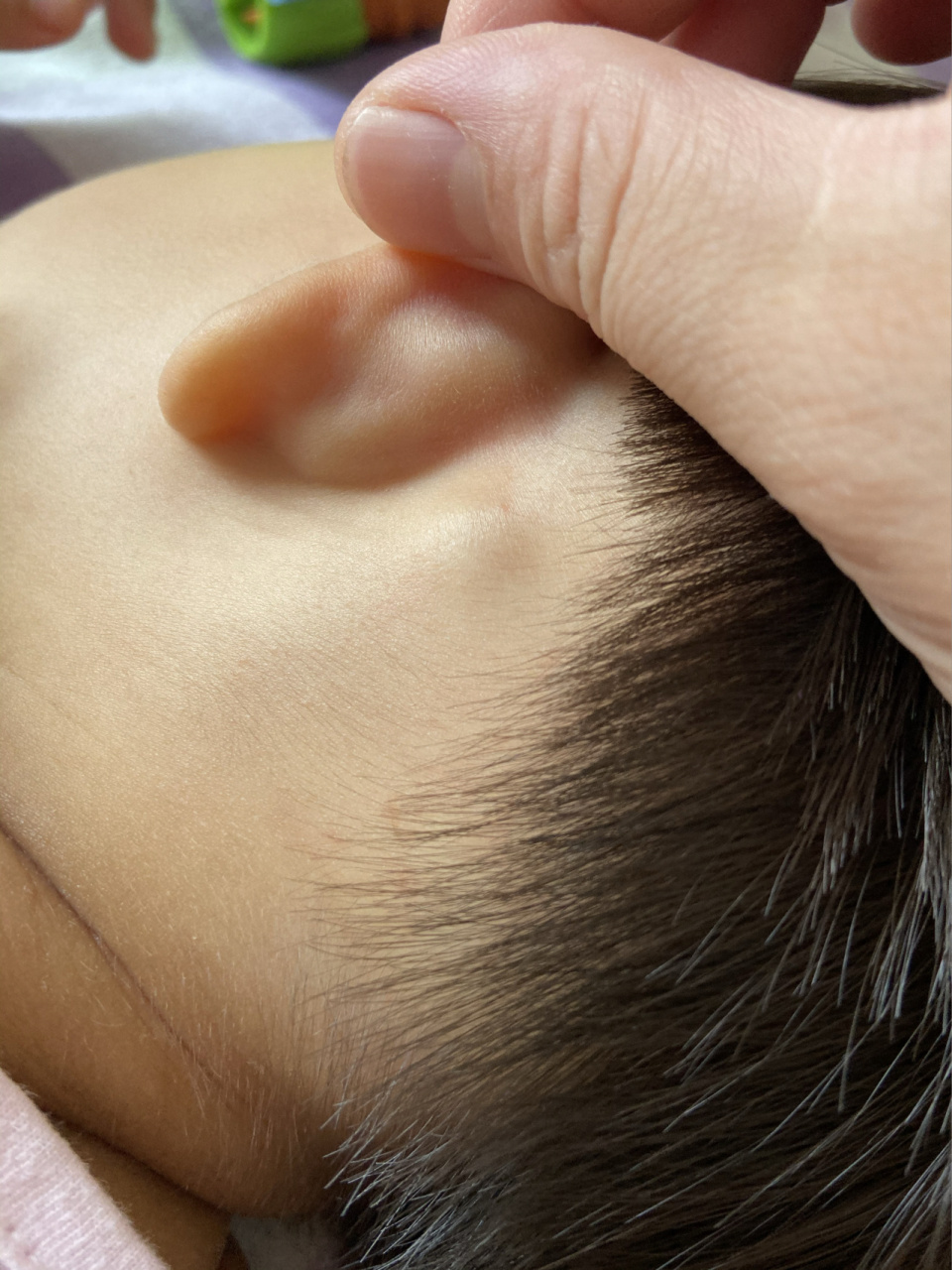 宝宝耳朵后筋疙瘩图片图片