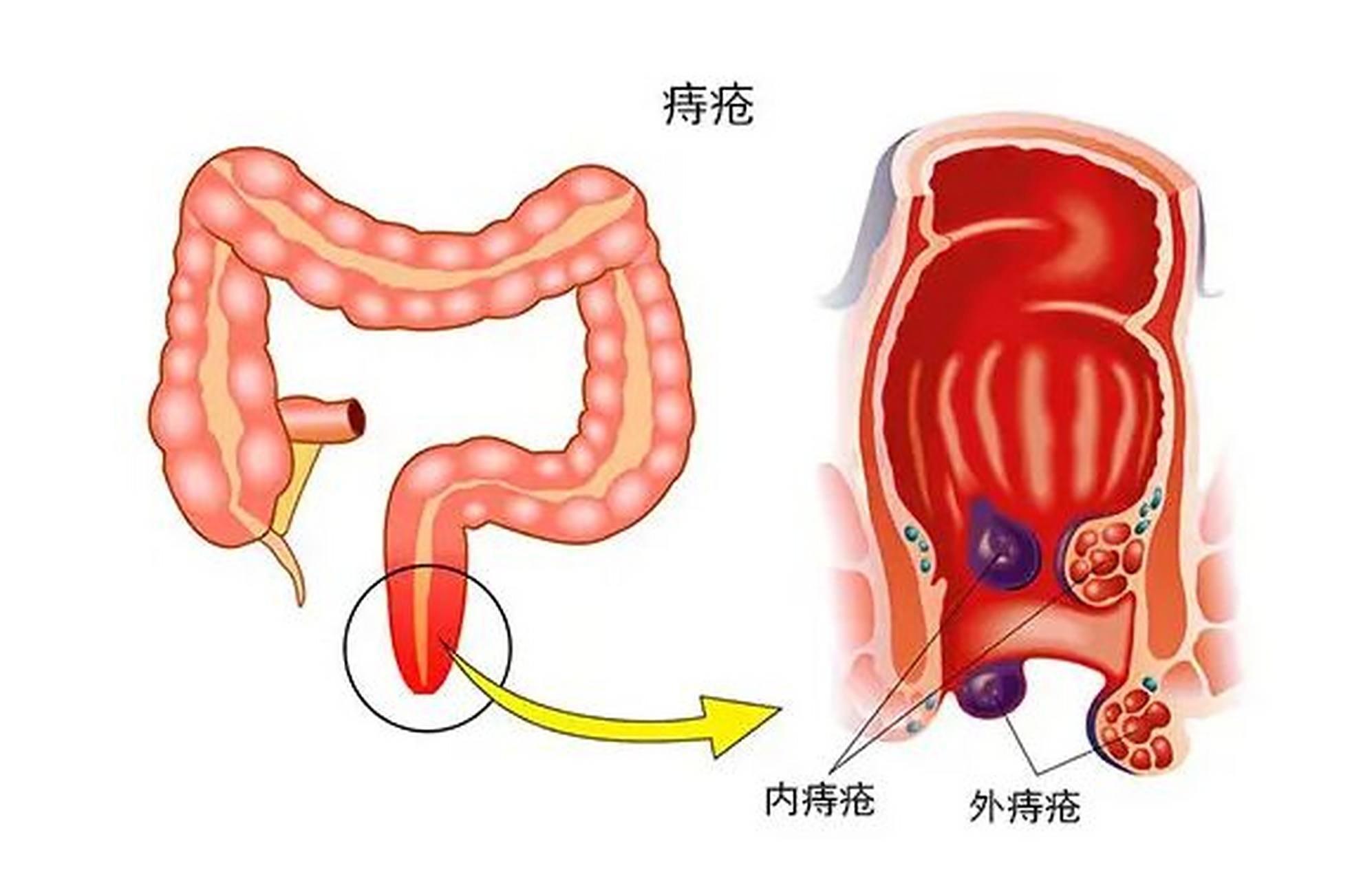 外痔和混合痔,常见的症状有以下几点: 一,便血,是内痔最常见的症状