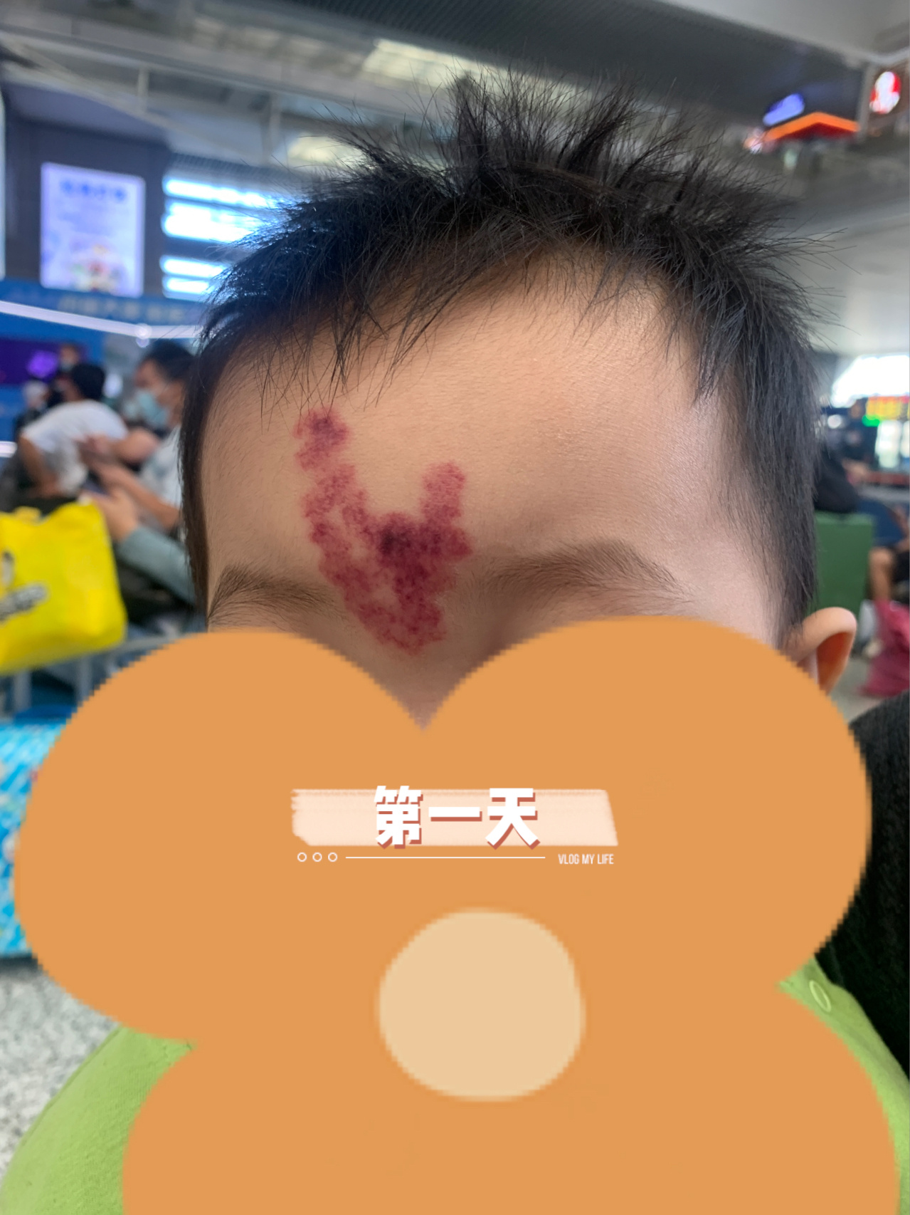 一岁半宝宝,鲑鱼斑激光恢复过程