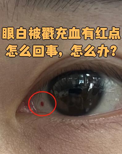 眼白被戳伤后出现充血和红点,可能是结膜损伤或眼球穿通伤