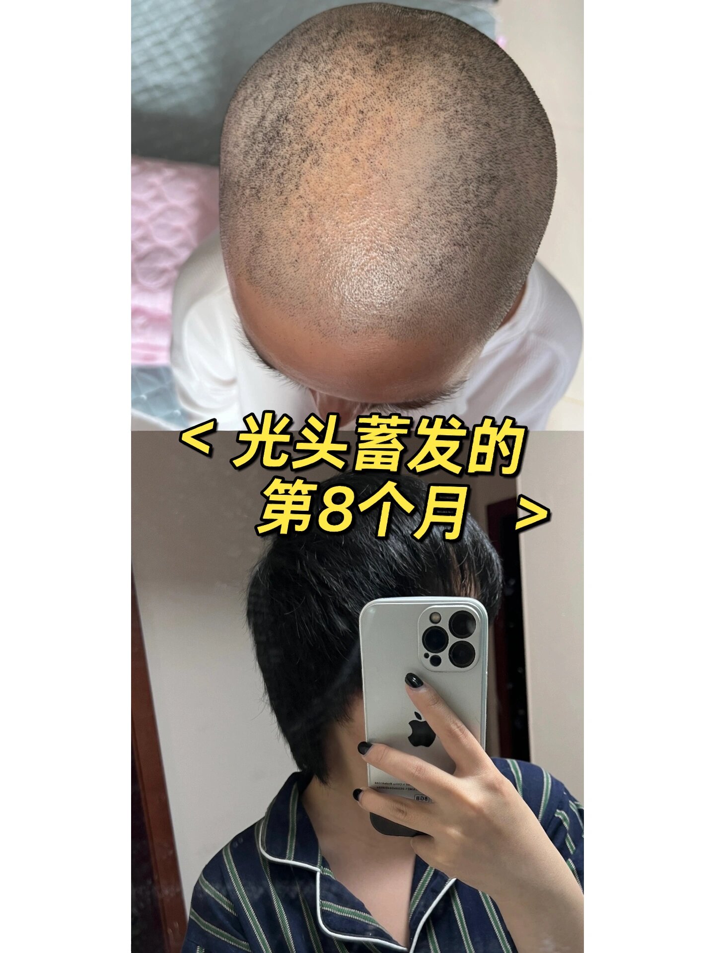 光头蓄发的第8个月