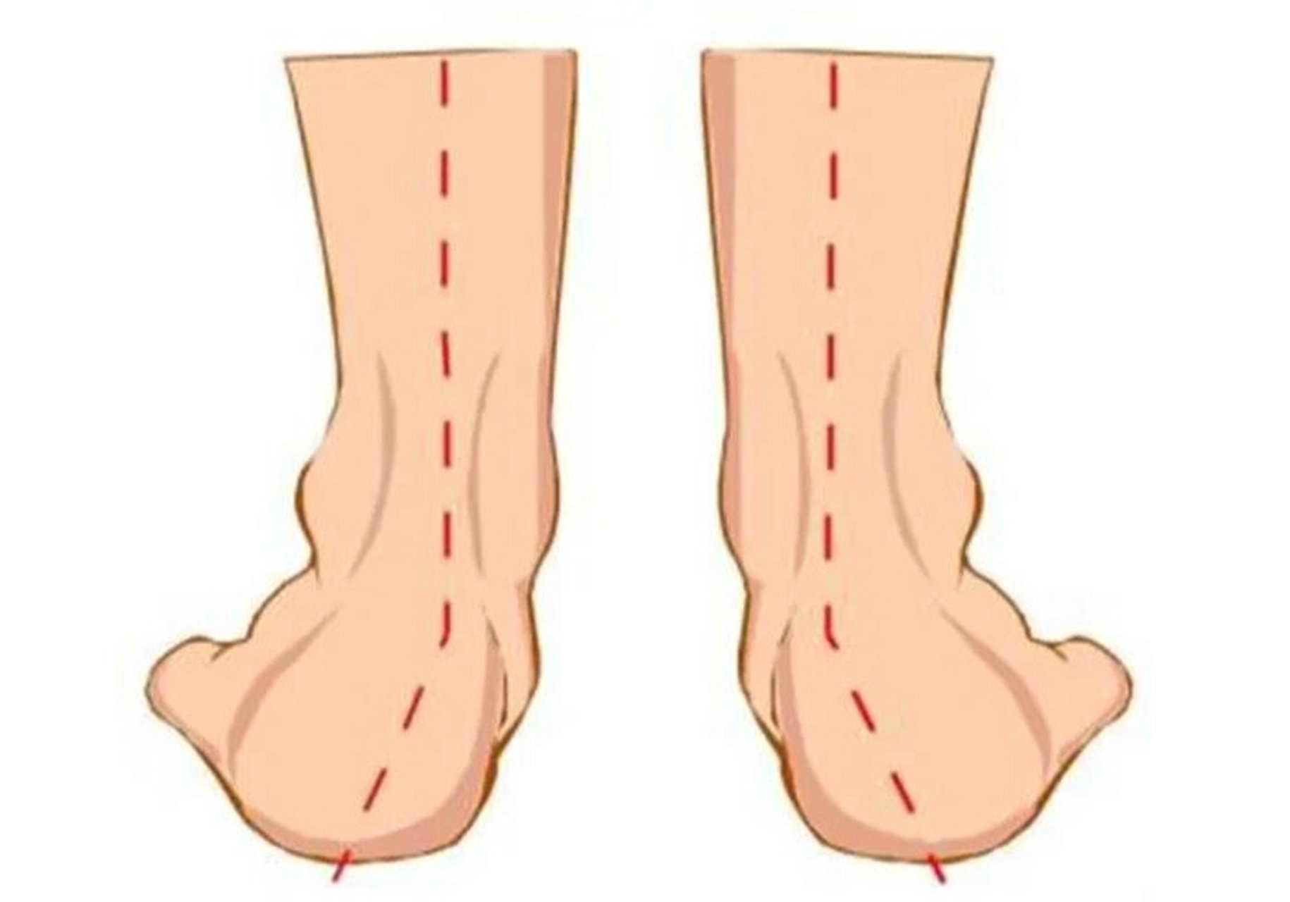 马蹄外翻足也叫作先天性畸形足,是一种比较常见的先天畸形,大多蔚单