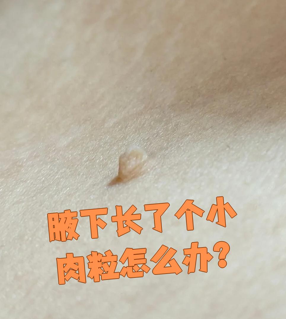 腋下长了个小肉粒怎么办?