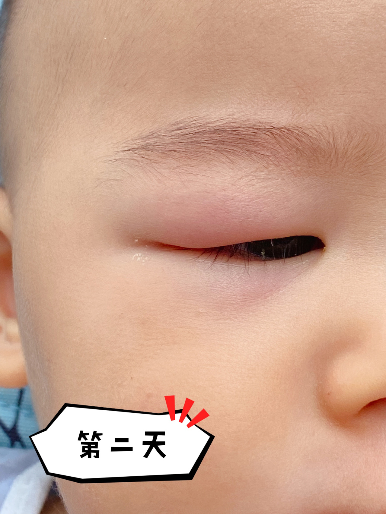 经验贴:10个月宝宝麦粒肿如何快速消退 第一天早上起床发现宝贝右眼上