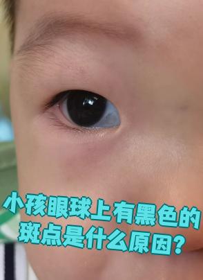 这是天生的良性肿瘤,看起来像白眼球上贴了黄色,褐色或黑色的小斑块