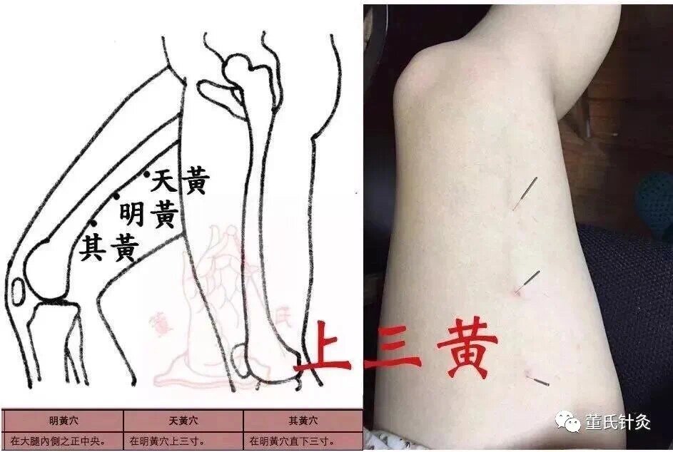上三皇穴位