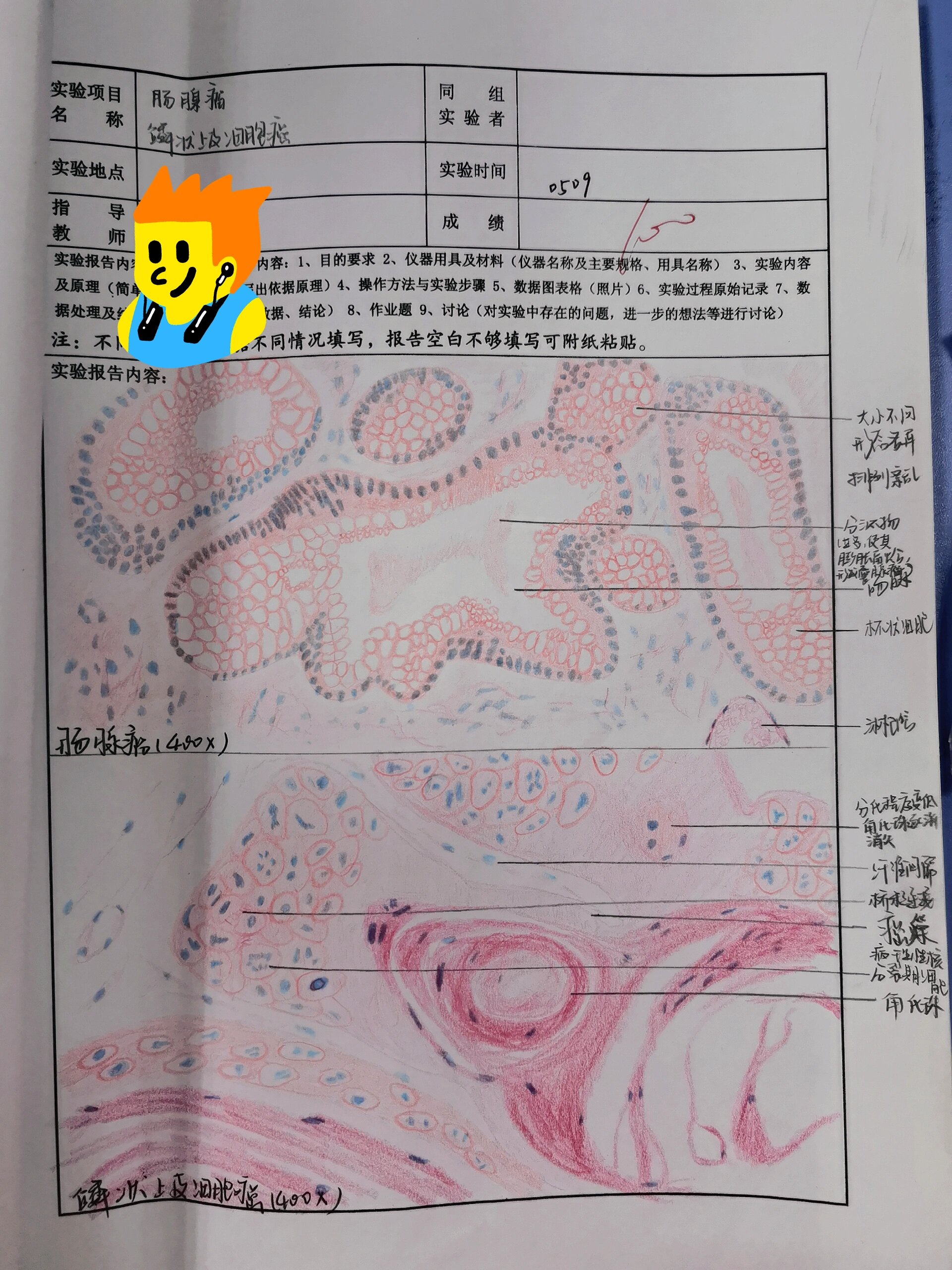 直肠腺癌红蓝铅笔绘图图片