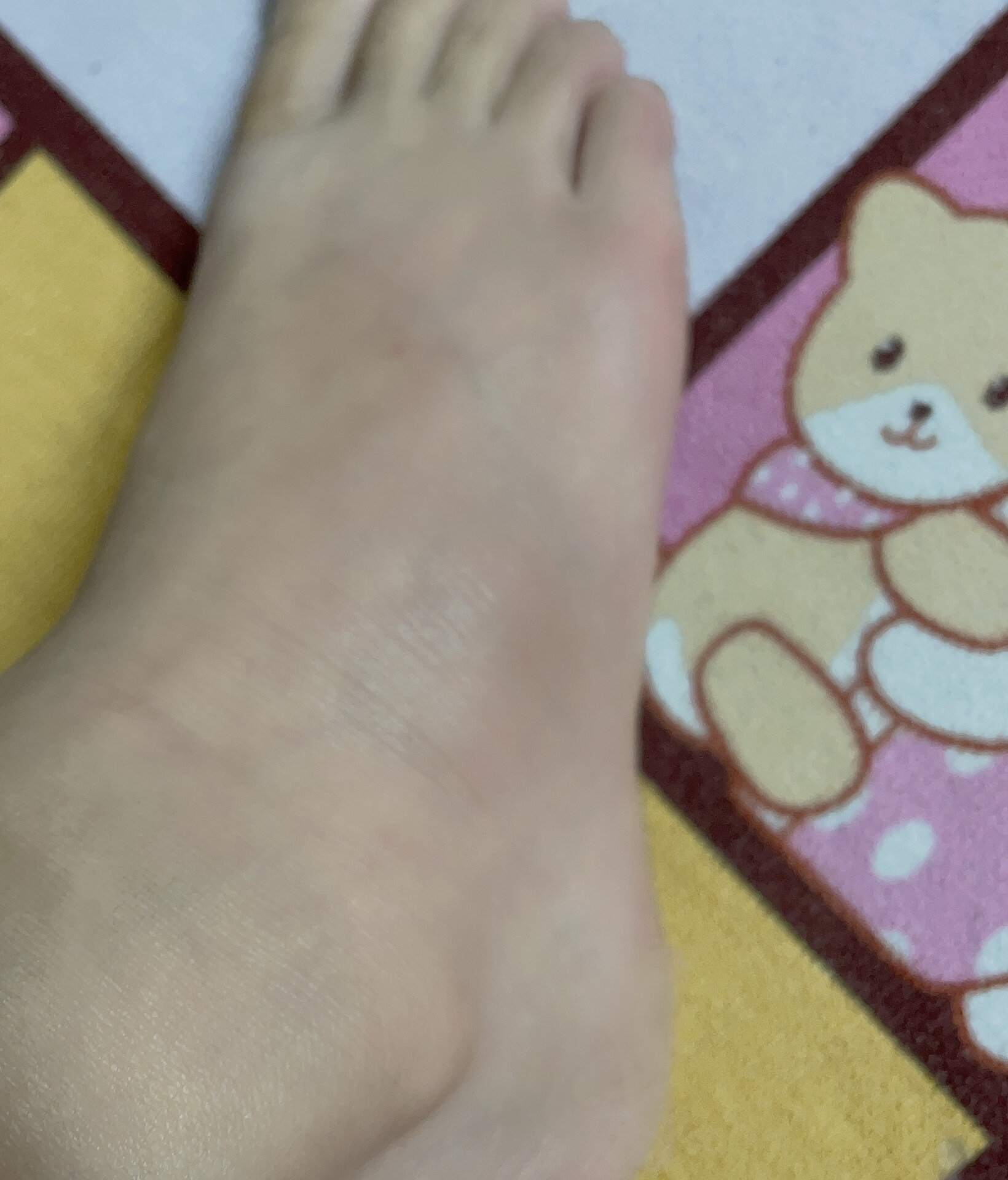 崴脚的第50天了,还是那么痛 脚背侧骨还是那么肿, 这种情况脚背侧骨