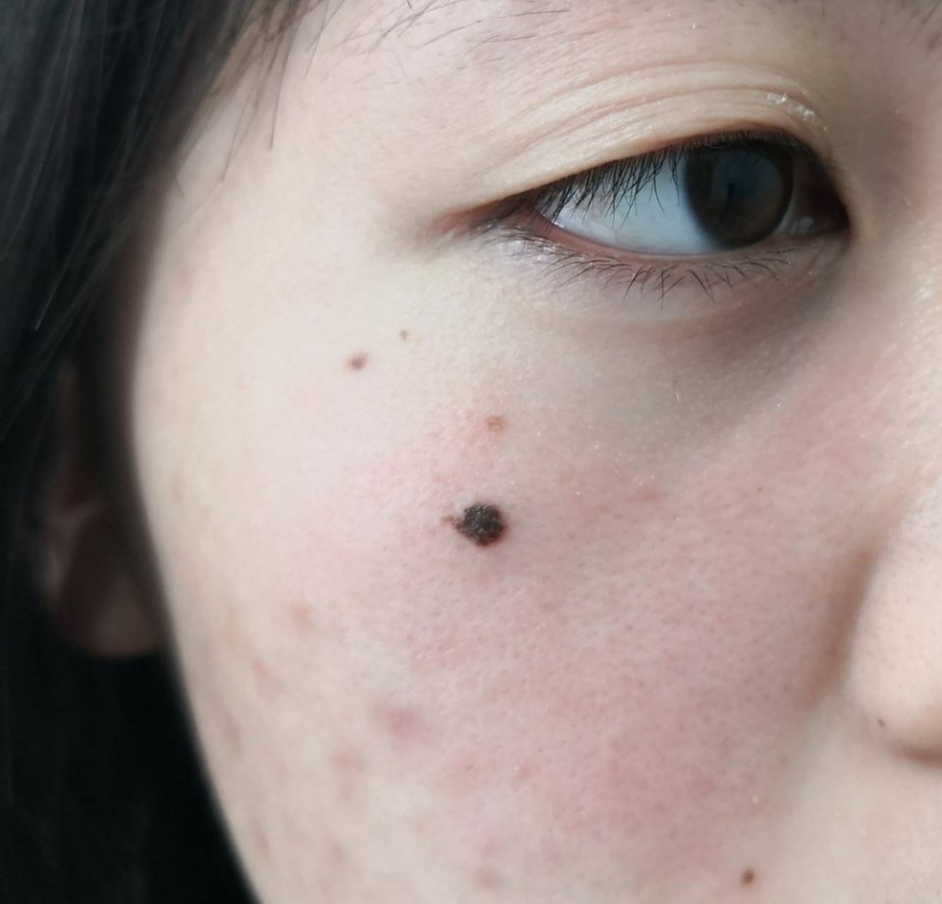 解决皮肤问题专注皮肤美容##色素痣